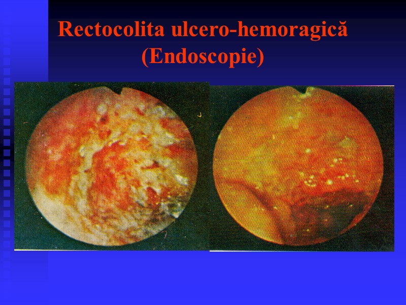 Rectocolita ulcero-hemoragică (Endoscopie)